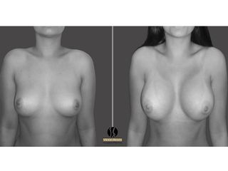Mamoplastia de aumento bilateral pre y post operatorio