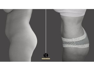 Lipoescultura pre y post operatorio