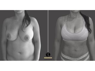 Lipoescultura pre y post operatorio