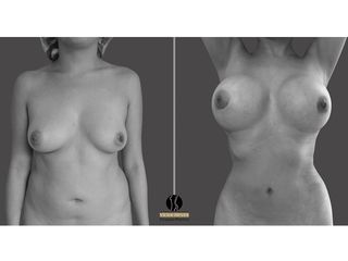 mamoplastia de aumento, lipoescultura