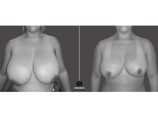 mamoplastia de reduccion bilateral