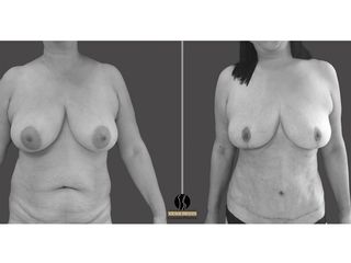 mastopexia, abdominoplastia  mas lipoescultura, paciente de 62 años