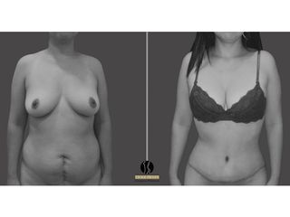abdominoplastia, lipoescultura, retiro de cicatriz abdominal