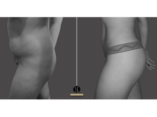 Lipoescultura pre y post operatorio, lipoinyeccion glutea