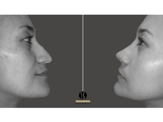 Rinoplastia pre  y post operatorio