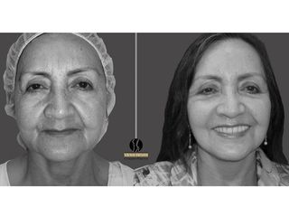 Rejuvenecimiento facial  pre y post operatorio