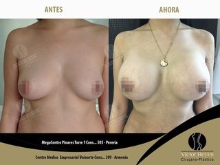 Mamoplastia de aumento mas lipoescultura