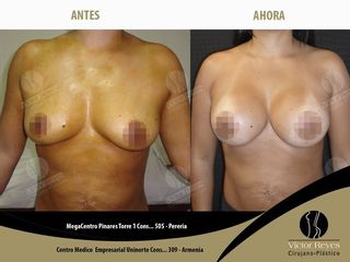 Implantes mamarios o Mamoplastia de Aumento