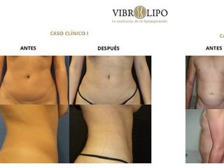 Antes y despues de lipoescultura