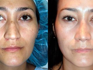 Antes y despues de rinoplastia