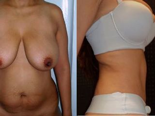 Antes y despues de abdominoplastia