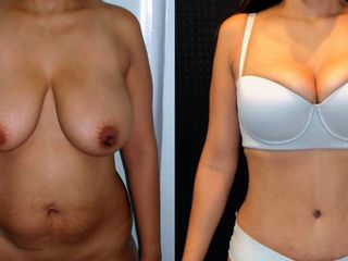 Antes y despues de abdominoplastia