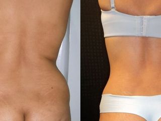 Antes y despues de abdominoplastia
