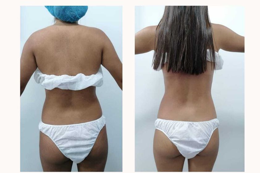 Celulitis antes y después - 816047