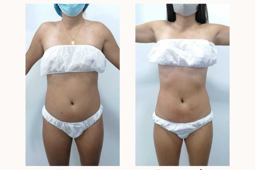 Celulitis antes y después - 816048
