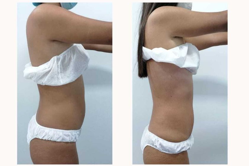 Celulitis antes y después - 816050