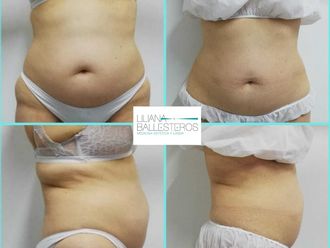 Celulitis antes y después - 816051