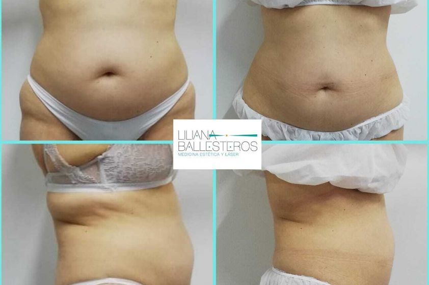 Celulitis antes y después - 816051