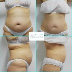 Lipo wave - Dra. Liliana Ballesteros