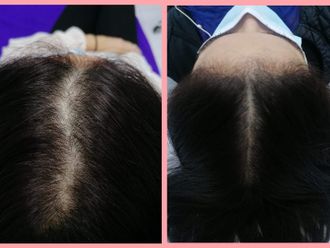 Tratamientos para el cabello - 816052