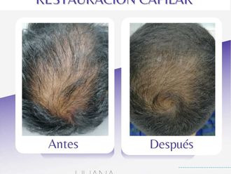 Tratamientos para el cabello - 816054