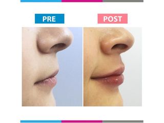 Aumento de labios - Doctora Alexandra Mora