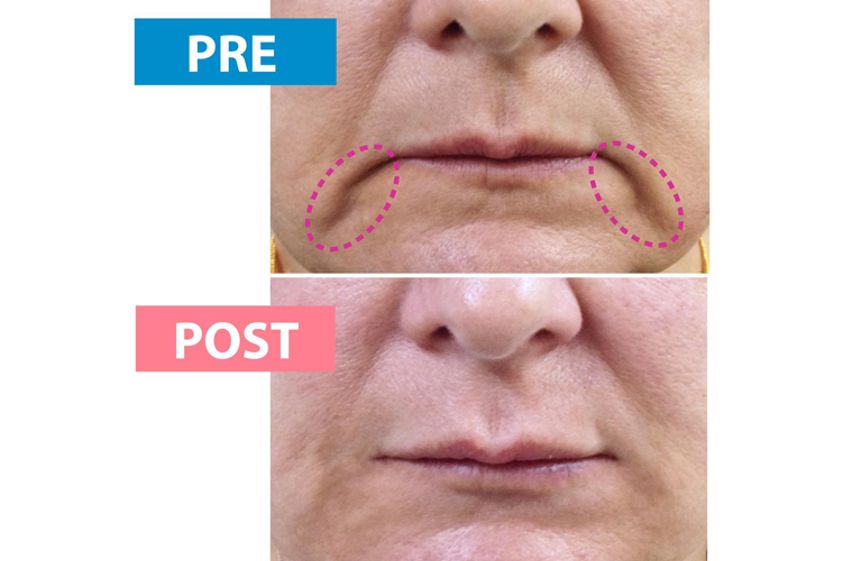 Bótox antes y después - 687778
