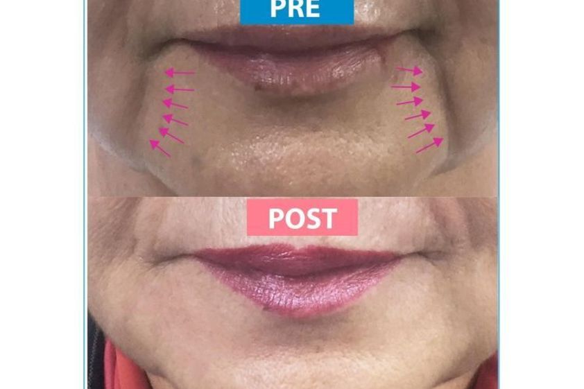 Bótox antes y después - 695982