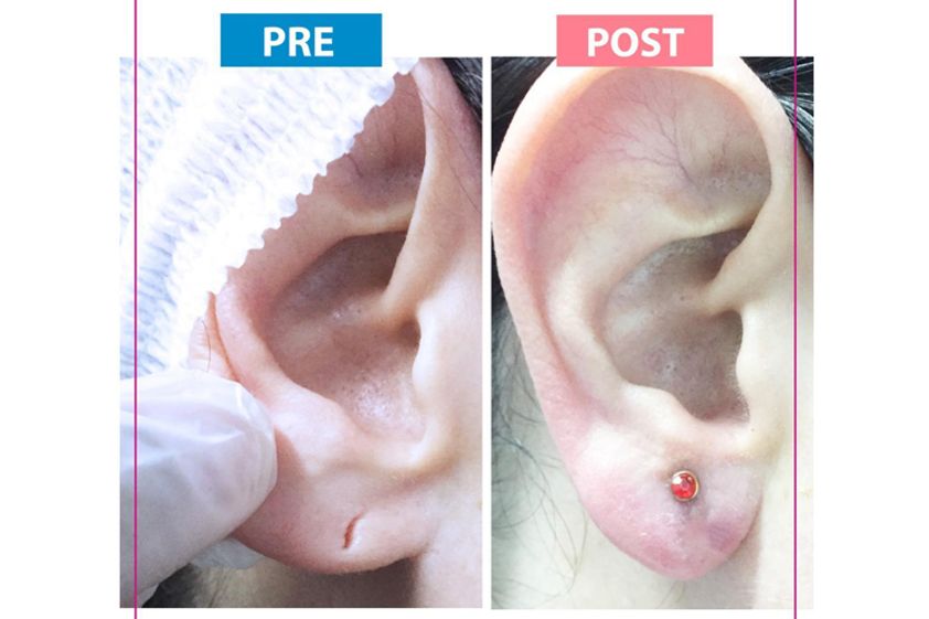 Otoplastia antes y después - 698200