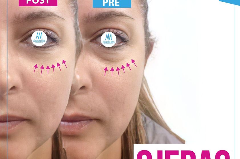 Eliminar ojeras antes y después - 807953