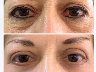 Blefaroplastia antes y después - 878706