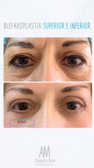 Blefaroplastia Superior - Doctora Alexandra Mora