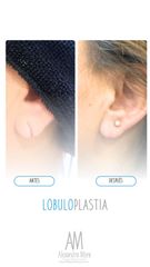 Lobuloplastia - Doctora Alexandra Mora