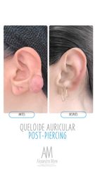 Queloide Auricular - Doctora Alexandra Mora