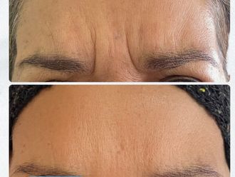 Bótox antes y después - 878709