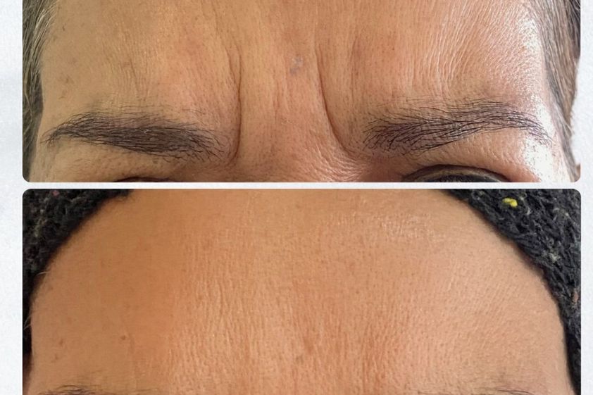 Bótox antes y después - 878709