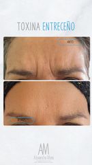 Bótox entreceño - Doctora Alexandra Mora
