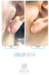 Lobuloplastia - Doctora Alexandra Mora
