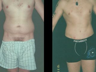 Abdominoplastia