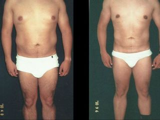 Antes y despues de abdominoplastia