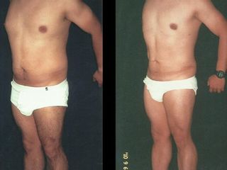 Antes y despues de abdominoplastia