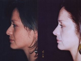 Antes y despues de rinoplastia