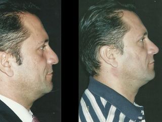 Antes y despues de rinoplastia