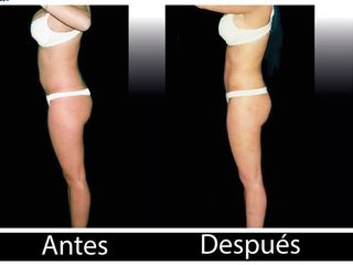 Antes y despues de abdominoplastia