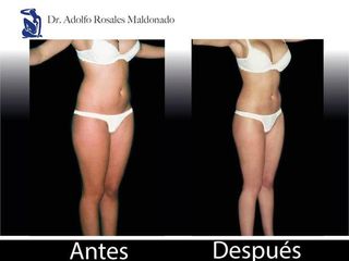 Antes y despues de abdominoplastia