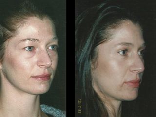 Antes y despues de rinoplastia