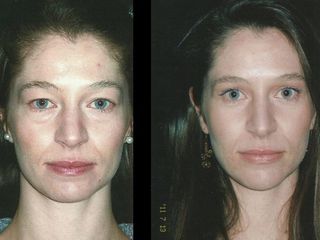 Antes y despues de rinoplastia