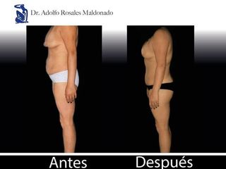 Antes y despues de abdominoplastia