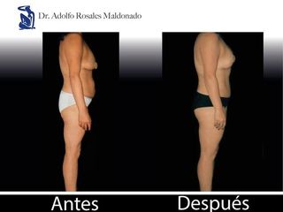 Antes y despues de abdominoplastia