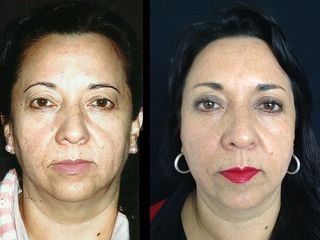 Antes y despues de rinoplastia